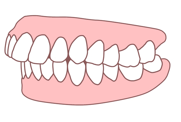 出っ歯でお悩みの方